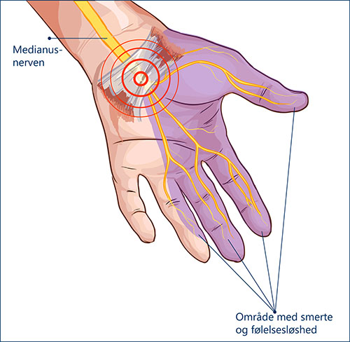 Illustration af karpaltunnelsyndrom.