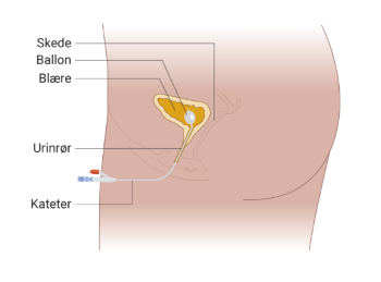 Illustration der viser placeringen af blærekateteret