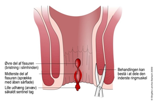 Anatomisk tegning, der viser, hvordan en rift i endetarmen ser ud, og hvordan det kan behandles for eksempel ved at dele den inderste ringmuskel.