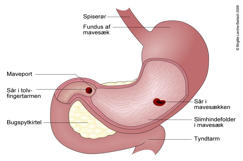 Illustration der viser blødende mavesår