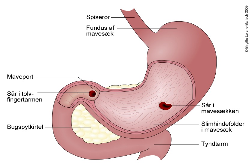 blødende mavesår 1.jpg