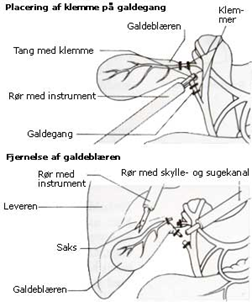 Billedet viser, hvordan galden løber direkte fra leveren ind i tyndtarmen, når galdeblæren er fjernet.