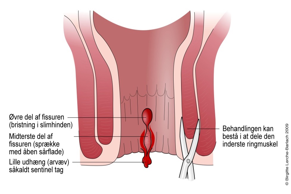 Billedet viser en forstørrelse af den nederste del af endetarmen, hvor der er vist en fissur, en rift i slimhinden, samt en saks, der viser hvor lægen laver et lille snit, gennem den inderste ringmuskel, som herved deles. Yderste ringmuskel indgår ikke i snittet