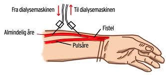 En AV-fistel er en operation, hvor en pulsåre og en blodåre i armen bliver syet sammen, så blodåren bliver større og velegnet til at blive stukket i.