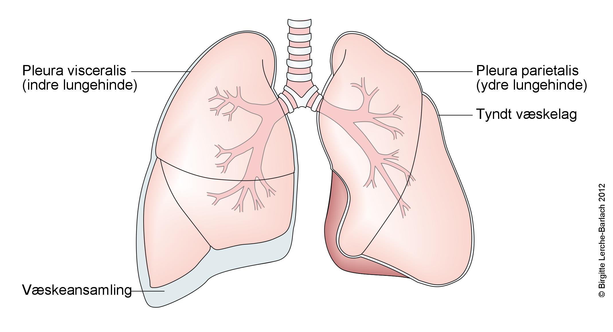 Illustration af lungerne, hvor der er en væskeansamling i lungehulen mellem den indre og ydre lungehinde.