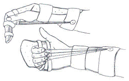 Tegninger af en hånd med kleinertstrækskinne set fra siden af og set fra undersiden