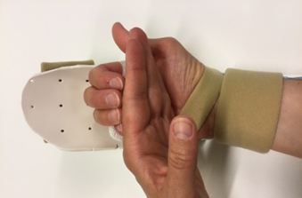 Hånd i plastskinne, hvor fingrene kradser blidt på bagsiden af den anden hånds fingre