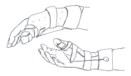 Tegninger af en hånd med kleinertstræk-skinne til tommelfingeren set fra siden og set fra håndfladen af