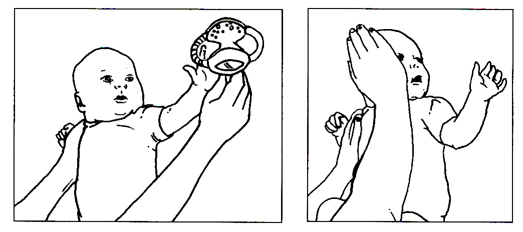 Tegning af liggende barn, der drejer hovedet til venstre og tegning af hånd der passivt drejer barnets hoved til venstre