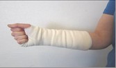 Arm i gips knytter fingrene