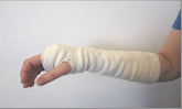 Arm i gips er drejet med fingrene nedad