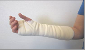 Arm med gips er drejet med fingrene opad