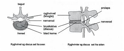 Tegning af ryghvirvler, hvor diskusskiven har en udbulning, som trykker på rygmarven eller nerve