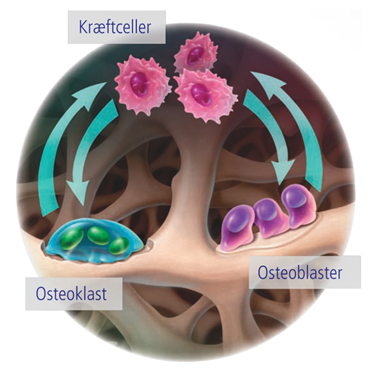 Figuren viser kræftcellernes virkning på knoglerne.