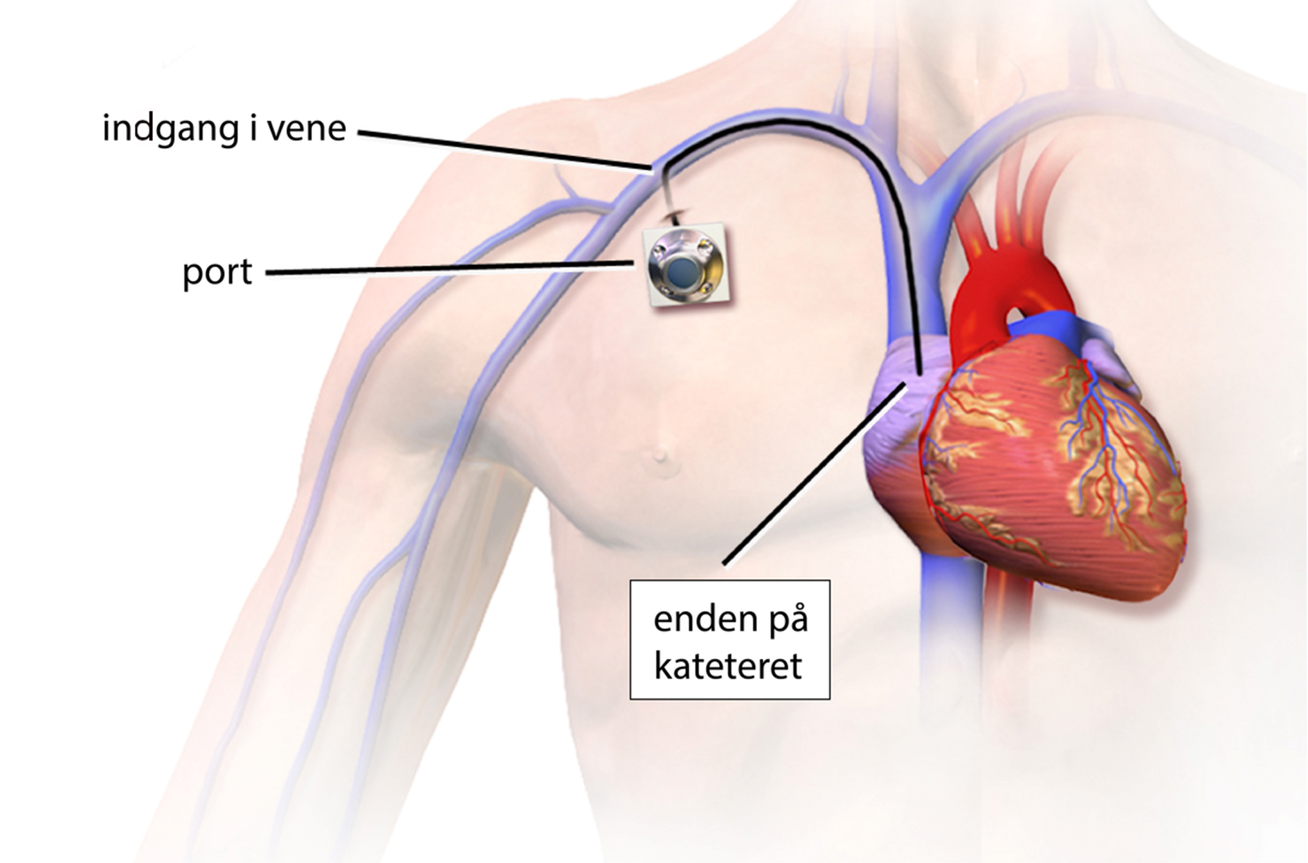 Billede af hvor injektionsporten ligger