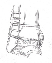 Illustration af knoglerne ved ankelleddet med flere indsatte skruer efter en operation.