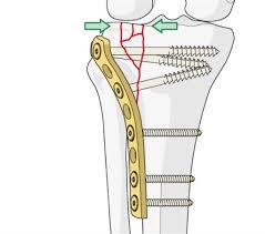 Brud i knæets bærende ledflade sat sammen med skruer og skinne