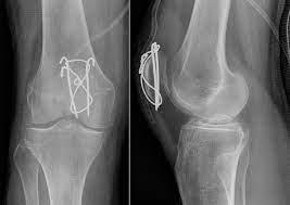 Brud i knæskallen, der holdes sammen med metalpinde og tråd