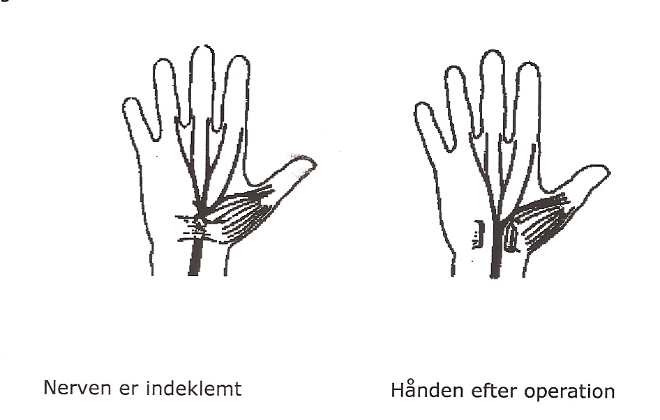 Til venstre ses en hånd med en indeklemt nerve, til højre ses hånden efter operationen, hvor nerven ikke længere er indeklemt.