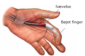Tegning af hånd med en bøjet finger og senen, der forårsager dette