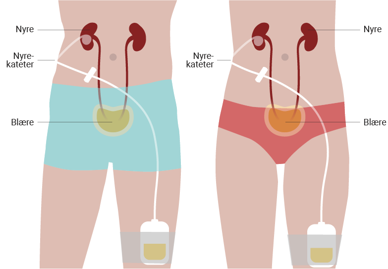 Illustration der viser hvordan ballonnyrekateteret sidder
