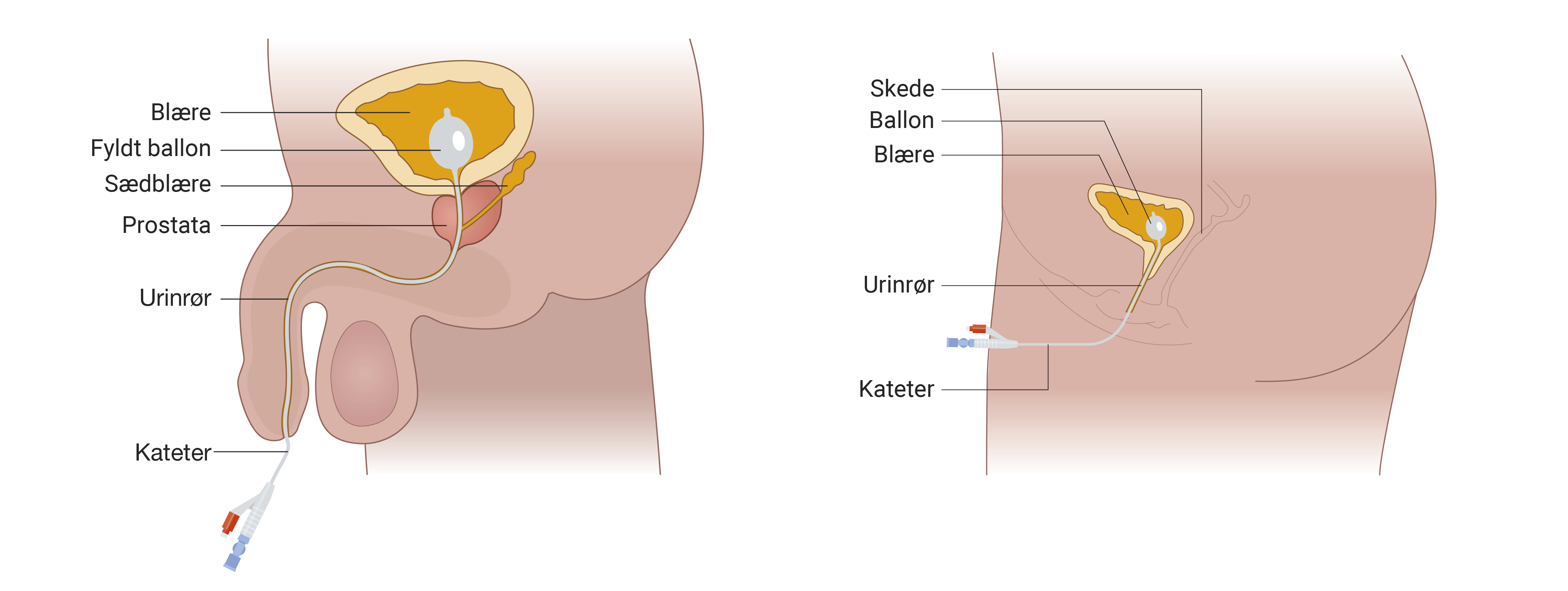 Illustration der viser blærekateter hos hhv kvind og mand