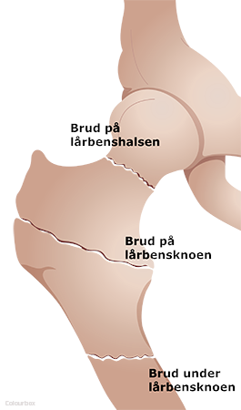 detekterbare klarhed radiator Information efter brud i hoften - Regionshospitalet Gødstrup