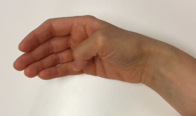 Billede af hånd, hvor tommelfingeren bøjes ned til basis af lillefingeren