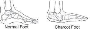 Figuren viser en normal fod til venstre og en Charcot-fod til højre.